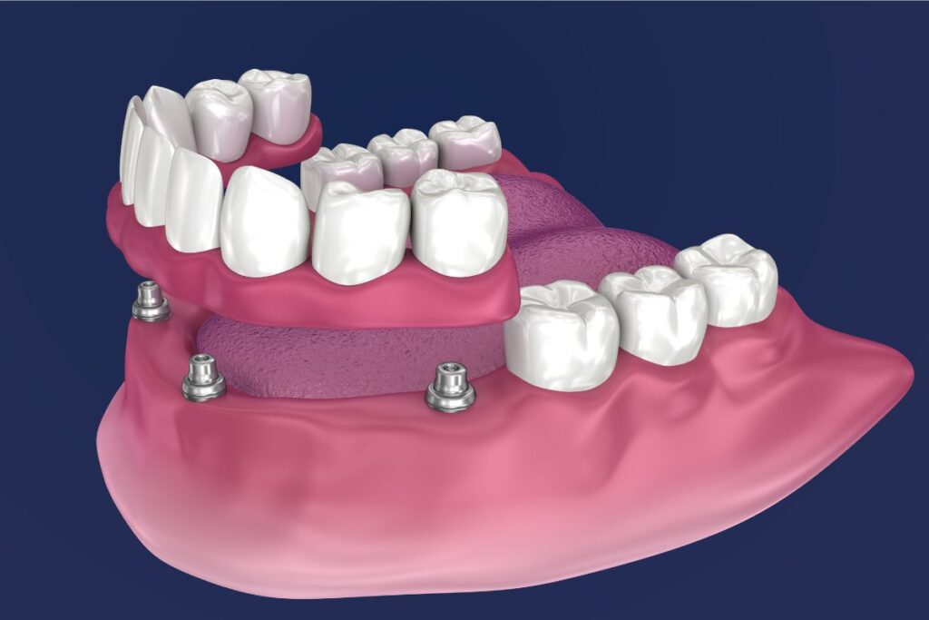 All On 4 Dental Implants